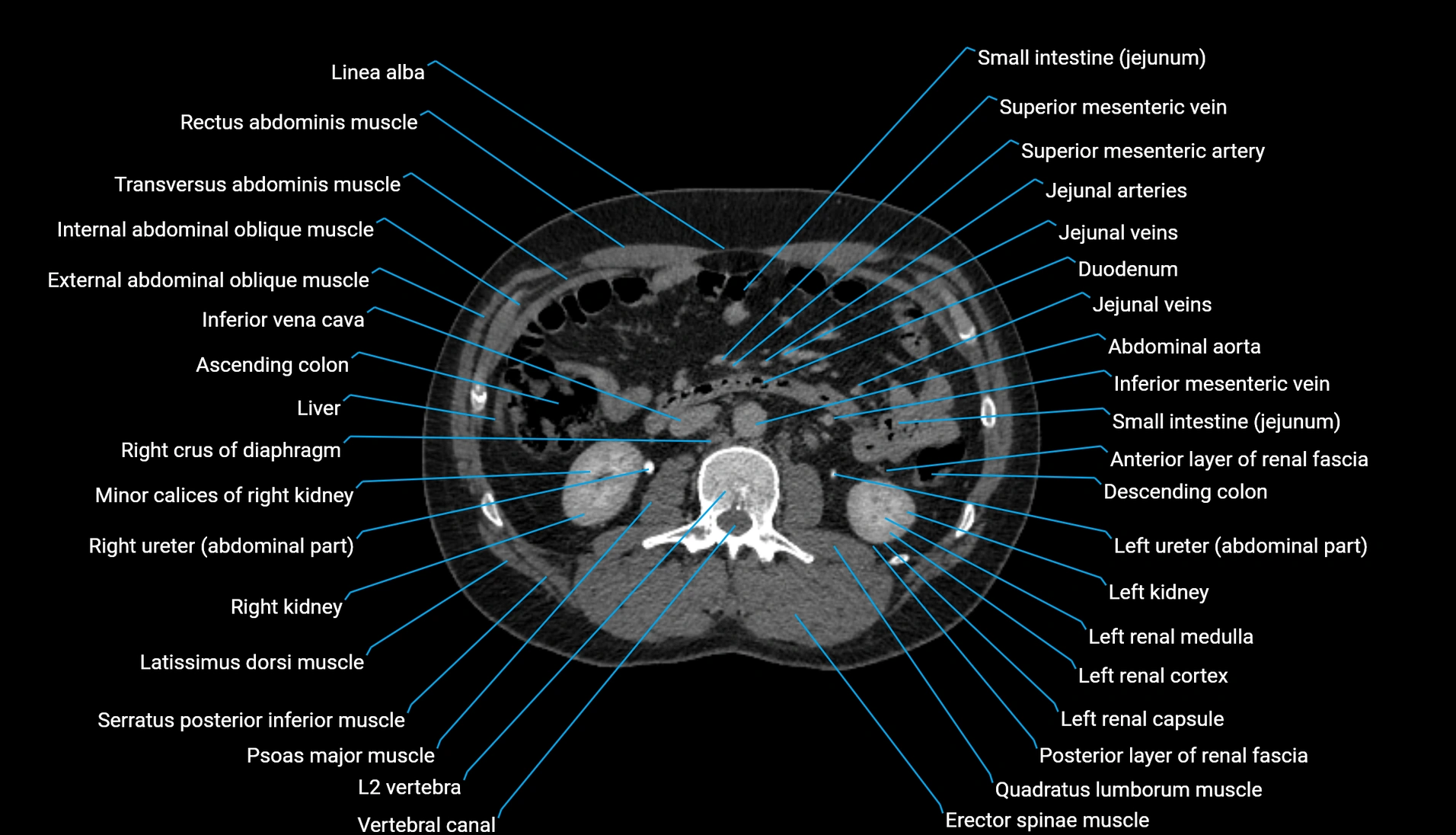 CT urogram axial cross sectional anatomy  labelled radiology image-00115.webp